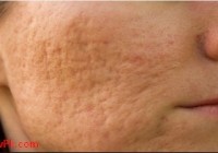 how to remove acne scars in one day by home Remedies [howpk.com]