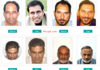 5 Best Hair Transplants in Pakistan [howpk.com]