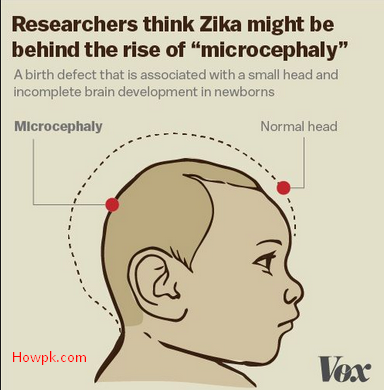 Zika Virus a Viral Infection - Threats, Symptoms and Prevention [howpk.com]